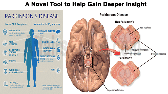A novel tool to help gain deeper insight into Parkinson’s disease
